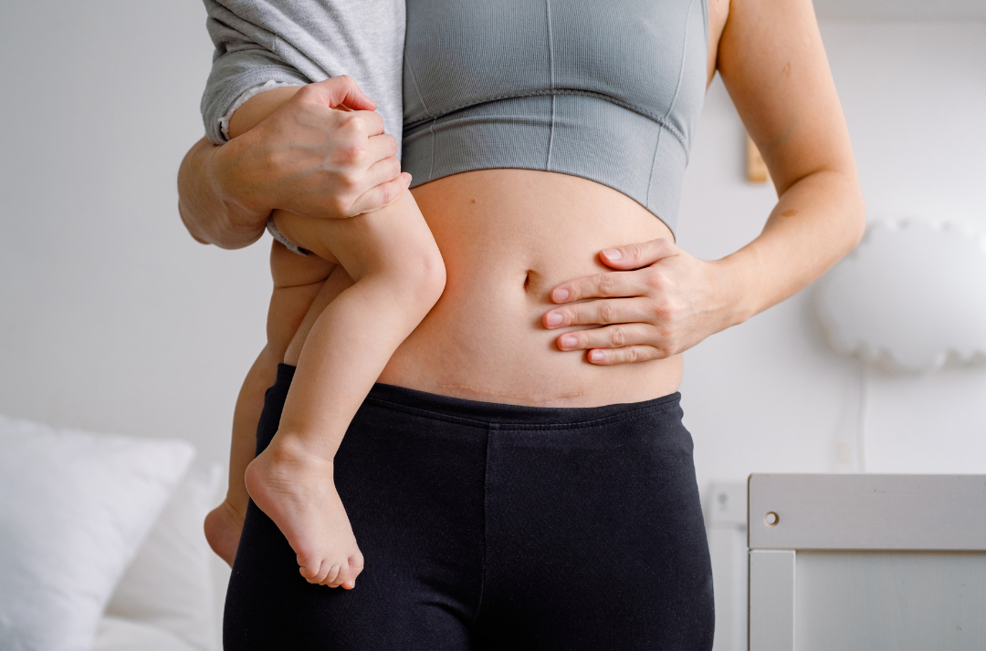 Waist Training After Pregnancy